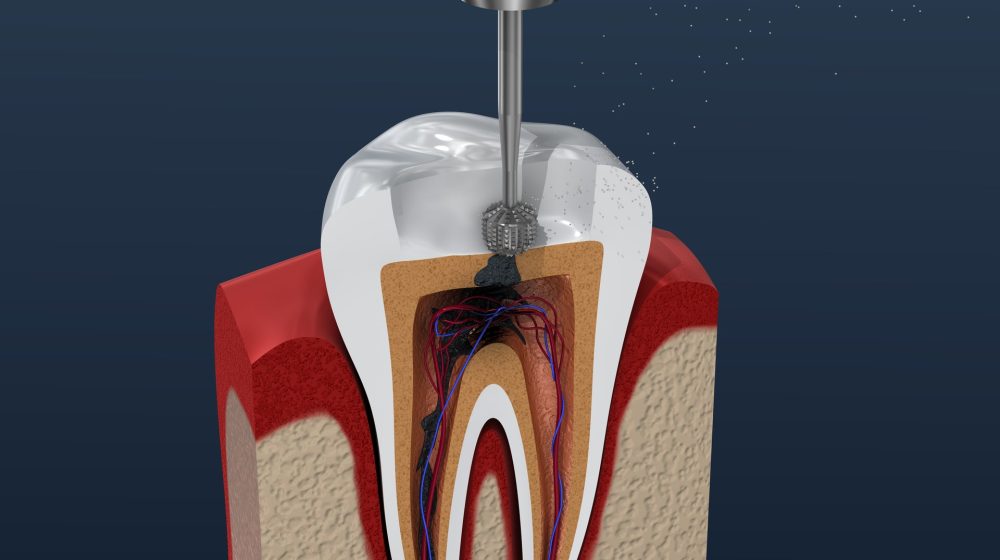 Endodoncia-min