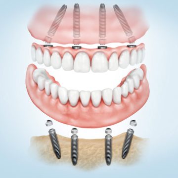 dentadura-fijada-implantes-allonfour